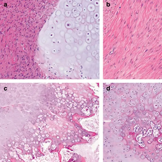 fibrocartilaginous mesenchymoma of bone